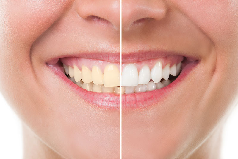 Teeth Whitening - Richard W. Pacelli DDS, La Grange Dentist